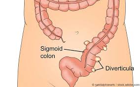 Bei einer ausgeprägten und wiederholten divertikulitis wird operiert. Divertikulitis Symptome Diagnostik Therapie Gelbe Liste