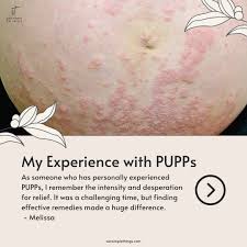 Image result for pruritic urticarial papules and plaques of pregnancy