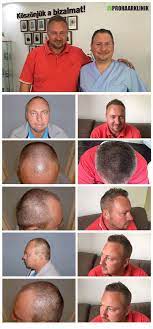 haartransplantation vorher nachher bilder der prohaarklinik ungarn haartransplantation haarverpflanzung haare