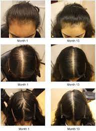 Shampoo Anti Hair Loss More Info Could Be Found At The Image Url Hair Loss Women Hair Loss Women Treatment Anti Hair Loss Shampoo