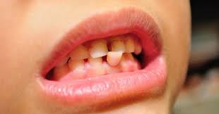It Is Not Necessary That All The Teeth Will Fall On Their Own Know The Tips To Pull Your Kid S Loose Tooth Wi Loose Tooth Loose Teeth Kids Loose Tooth Removal