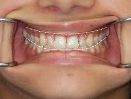 How to get braces for free in south africa. Dental Repairs Dental Surgery Orthodontics Walmer Port Elizabeth Dentists At Health