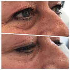 Under eye filler before and after. Tear Trough Filler Under Eye Filler M1 Med Beauty London Liverpool