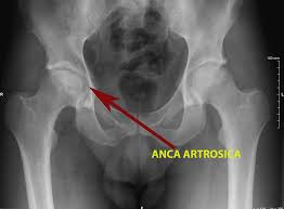 Artrosi Dell Anca Coxartrosi Quali Sono I Sintomi E Quali Le Cure L Altra Riabilitazione