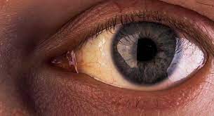 Gilbert S Syndrome Liver Doctor