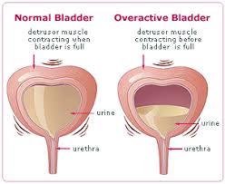 Image result for bladder infection