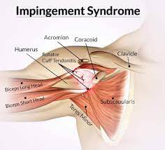 Jan 07, 2015 · nota pengakap 1. Cara Merawat Sindrom Impingement Bahu