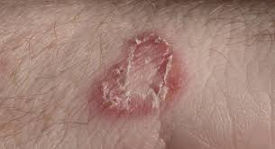 Sunlight will kill ringworm too. Dos And Don Ts To Treat Fungal Skin Infections Thehealthsite Com