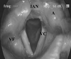 Image result for Reflux Laryngitis
