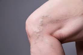 However, about half of adults have them, and they become more prevalent with age. Are You A Candidate For Varicose Vein Treatment Know More About This