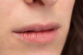 Winter Mouth Issues | Cracked Lips | Williamsburg Dental