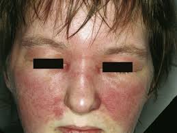 Image result for phlegmon on face)