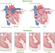 Image result for Ventricular Septal Defect