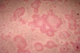 Image result for Papular urticaria