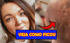 Surpreendente! Mulher exibe terrível queimadura nas costas após ir à praia  e usar 'protetor solar'; imagens fortes