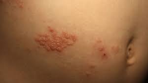 Standige Impfkommission Empfiehlt Gurtelrose Impfung Onmeda De