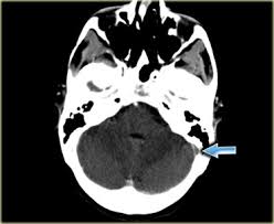 For the cerebral venous sinus thrombosis study group. The Radiology Assistant Cerebral Venous Thrombosis
