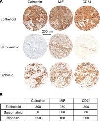 Unfortunately, the survival rate for mesothelioma is poor. Cd74 A New Prognostic Factor For Patients With Malignant Pleural Mesothelioma British Journal Of Cancer