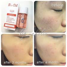 Bio Oil Gel Before And After Vamos Comecar O Dia Cheio De Esperanca E Motivacao Olha Que Tudooooo Essa Transformacao Que O Bio Oil E Capaz De Skin Care Tips Skin Bleaching Simple Skincare