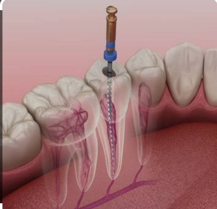 Root canal treatment in Mira Road product image