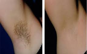 Laser facial hair removal often lasts as long as eight weeks. Laser Hair Removal Glowday