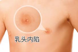 男人一个乳头内陷正常吗图片_39健康网