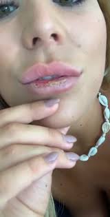 Bisse auf die lippe sind ebenfalls zu vermeiden. Kussen Tat Weh Bachelorette Chanelle Holt Sich Uble Lippenverletzung Bei Dreh 20 Minuten