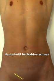 Ein leistenbruch (inguinalhernie) ist eine erkrankung, bei der das intraabdominelle fettgewebe oder ein teil des dünndarms durch eine schwachstelle der unteren bauchmuskulatur hervortritt. Leistenbruch Op In Nurnberg Klinik Hallerwiese De