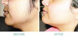 Feb 22, 2021 · to remove the unwanted hairs, the follicles must be present in your skin whenever you are using the light. Laser Hair Removal Treatment Kochi Laser Hair Removal Clinic Kerala