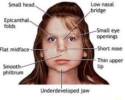 In asians it is normal, but in caucasians it may indicate an underlying syndrome. Nasal Epicanthal Folds Flat Midface Short Nose Thin Upper Smooth Lip Underdeveloped Jaw Ifunny