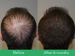 Astaxanthin is a reddish pigment that belongs to a group of chemicals called carotenoids.astaxanthin is found in yeast, salmon, trout, shrimp, crayfish, crustaceans, and some algae (hematococcus pluvialis). Kmax Hair Growth Capsules Hair Growth Specialist
