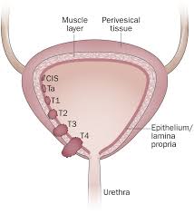 More than 90 percent of bladder cancers start in the cells that make up the innermost lining of the bladder wall. Landmarks In Non Muscle Invasive Bladder Cancer Nature Reviews Urology