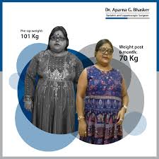 Life after gastric bypass surgery. Mini Gastric Bypass Surgery Mumbai Mgb Omega Loop Bypass Cost India Bestbariatricsurgeon Org