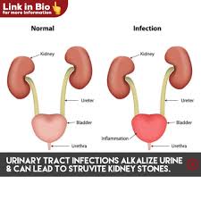Uti S Can Lead To Struvite Kidney Stones Kidney Stones Urinary Tract Infection Kidney