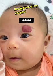 Hemangioma ការប្រៀបធៀបពីកំណើតដល់18ខែ
