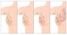 Ingrown Nipple Hair