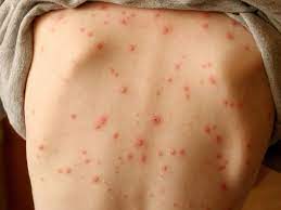 Maybe you would like to learn more about one of these? Skin Rash Should Be Considered Key Symptom Of Coronavirus Say Scientists Shropshire Star