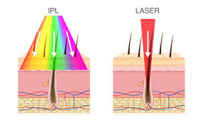Dann solltest du dich mit der innovativen laser haarentfernung auseinander, die seit einigen jahren mithilfe von ipl geräten. Warum Eignet Sich Der Diodenlaser Zur Haarentfernung Besser Als Ipl
