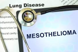 Each stage details how far the tumor has spread from where it first appeared in the pleura, the protective lining of the lungs. Mesothelioma Symptoms