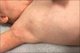 However it reappeared and now has been there since about a month and a half. A 10 Month Old Male With A Rash In The Axillae