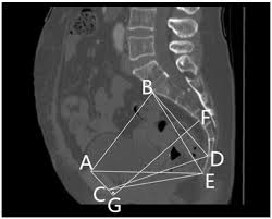 Image result for Pelvimetry
