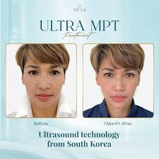 How does ultrasound treatment lift your face? Check out these amazing  results!☝🏻 Here are 3 reasons to choose Ultra MPT in TOSCA: 🏵️ Original &  verified technology from South Korea 🏵️ Done