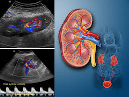 سونوگرافی کالرداپلر کلیه: سونوگرافی عروق کلیه و آمادگی ها لازم - سونوگرافی  سروش