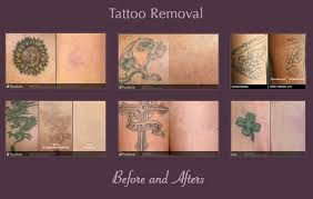 Picosure helps remove wrinkles, acne scarring, blemishes and tattoos—and now, with its unique focus option, picosure removes downtime as well. Picosure Tattoo Removal In Gainesville Fl Dermacare