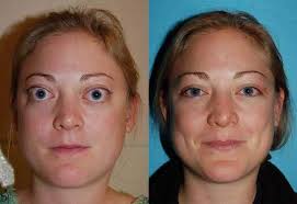 Maybe you would like to learn more about one of these? Eye Bulging Cv Optometry