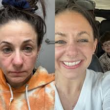 Before we check out for the memorial day weekend... KNOW this.. It's going  to sell out. Like fast. The filler... the non tox one. The natural one. The  "No way I don't