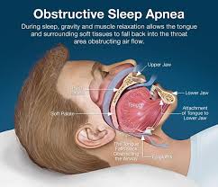 Image result for Obstructive Sleep Apnea