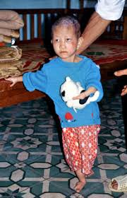 Dissemination of ao/dioxin disaster in vietnam reviewed the event featured 60 photos following the themes of ao/dioxin pains; Kinderhilfe Hyvong Vietnam Ev