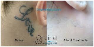 While this method might be effective for removing stick and poke tattoos, it should be noted that like salabrasion, it is painful. Laser Tattoo Removal Las Vegas Original You Advanced Laser