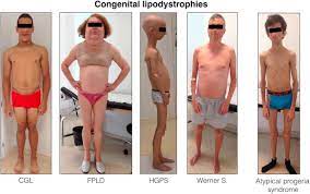 Pronunciation of the word(s) berardinelli seip syndrome. Congenital Generalized Lipodystrophy An Overview Sciencedirect Topics